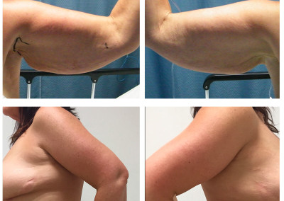 arm-lift-1-before-afters-combined