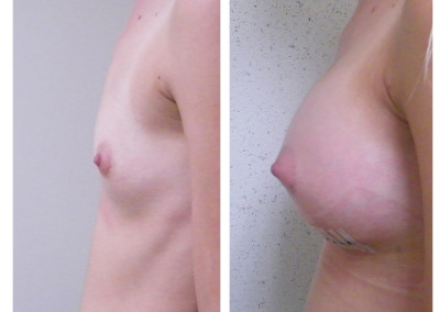 breast-implants-1