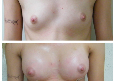 breast-implants-2