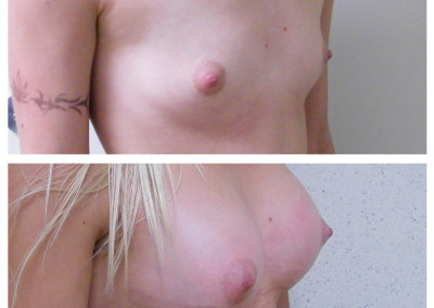 breast-implants-3