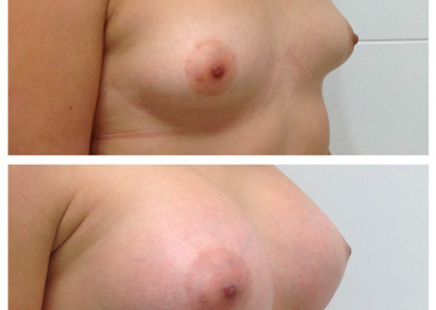 breast-implants-5