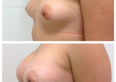 breast-implants-6