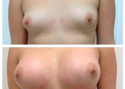 breast-implants-4