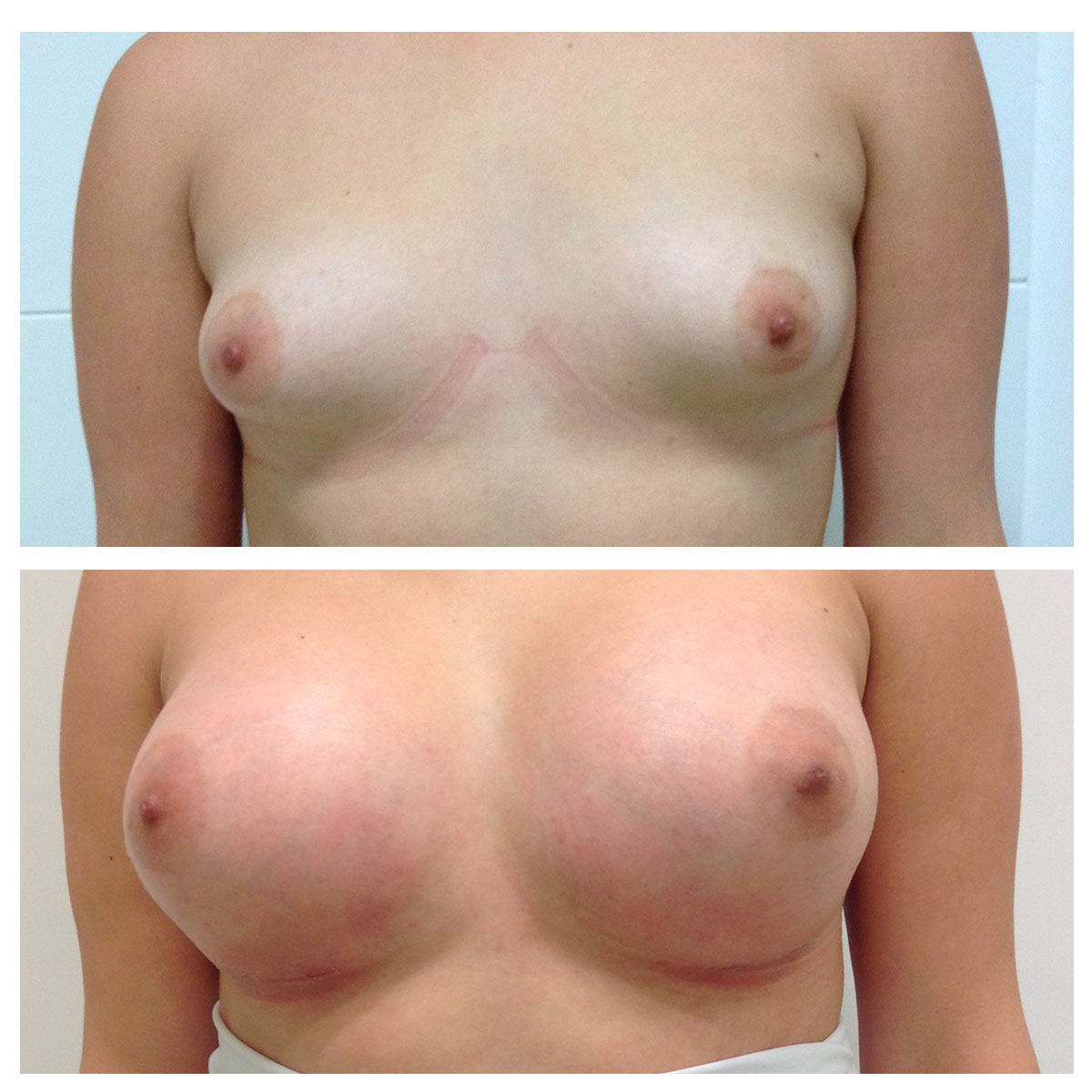2000cc Breast Implant Sizers